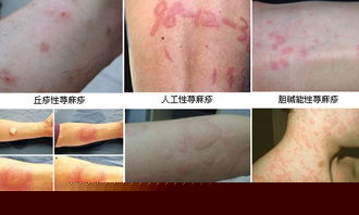 兰州北大皮肤科